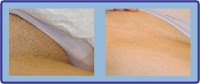 Laser Hair Removal Group 380384 Image 6